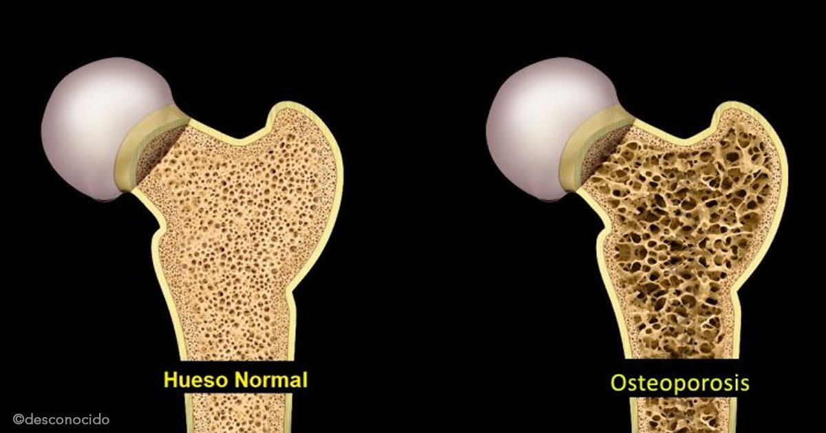 untitled 1 49.jpg?resize=1200,630 - Osteoporosis: Cómo prevenirla y consejos para fortalecer los huesos