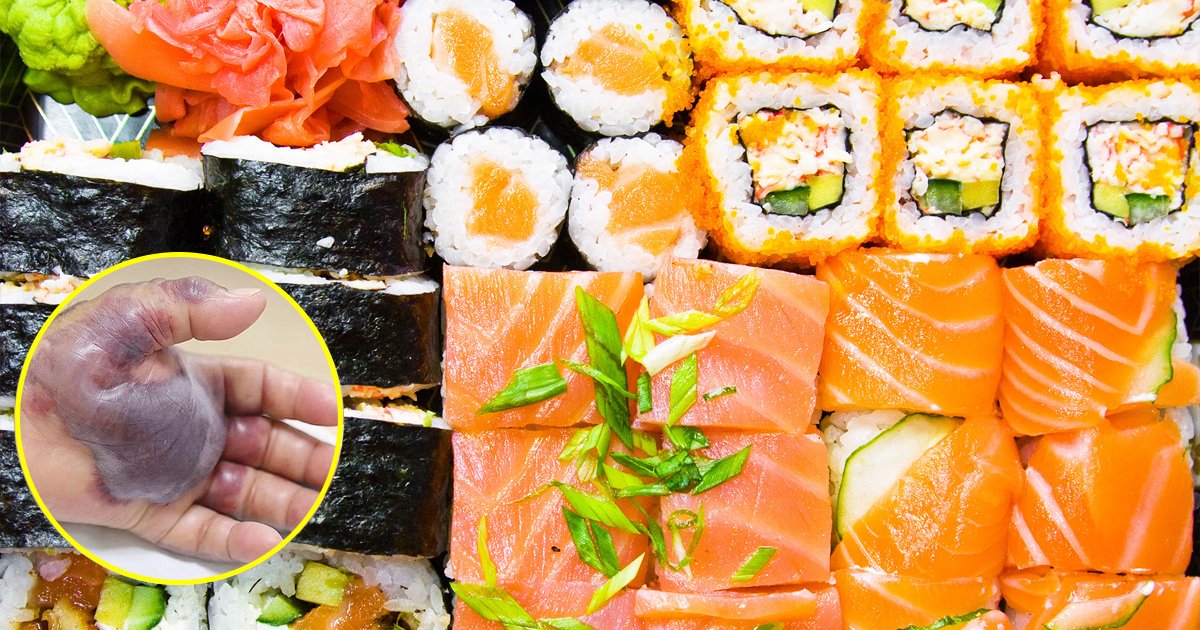 vgaaa.jpg?resize=412,275 - Fã de sushi tem mão amputada após contrair infecção bacteriana por comer peixe cru