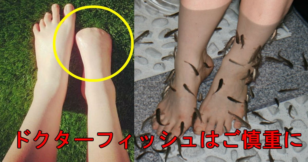 角質除去しようと ドクターフィッシュ を使用した結果 右足指 を全部失った女性 Hachibachi