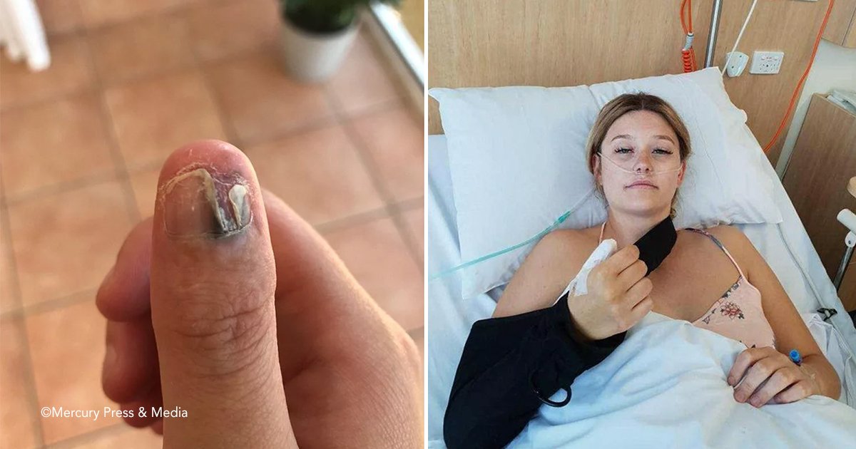 adad.jpg?resize=1200,630 - Una estudiante desarrolló una forma de cáncer de piel por morderse las uñas