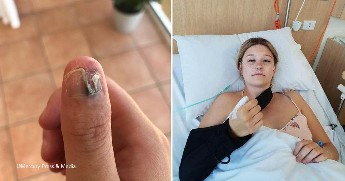 adad.jpg?resize=412,275 - Una estudiante desarrolló una forma de cáncer de piel por morderse las uñas