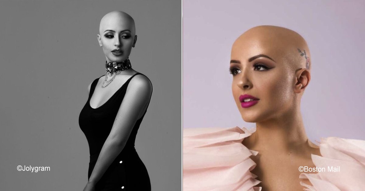 alopecia.jpg?resize=412,275 - Mujeres calvas crean #AlopeciaIsFashion, están convencidas que sin cabello se puede estar a la moda