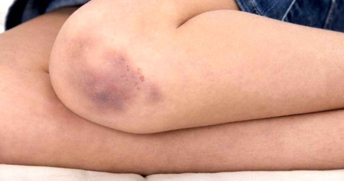 bruise.png?resize=412,275 - Hematomas aparecem em você sem motivo? Cuidado!