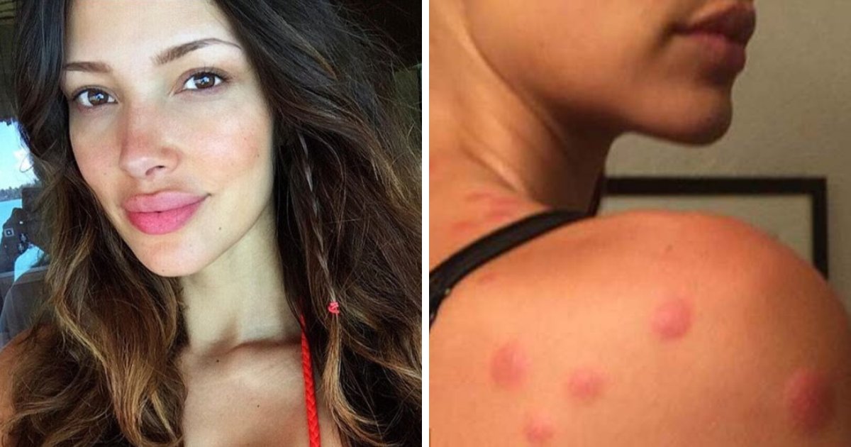 model2.png?resize=412,232 - Victoria’s Secret Model Sued A Hotel In California For Bed Bugs Saying She Had 90 Bites All Over Her Body