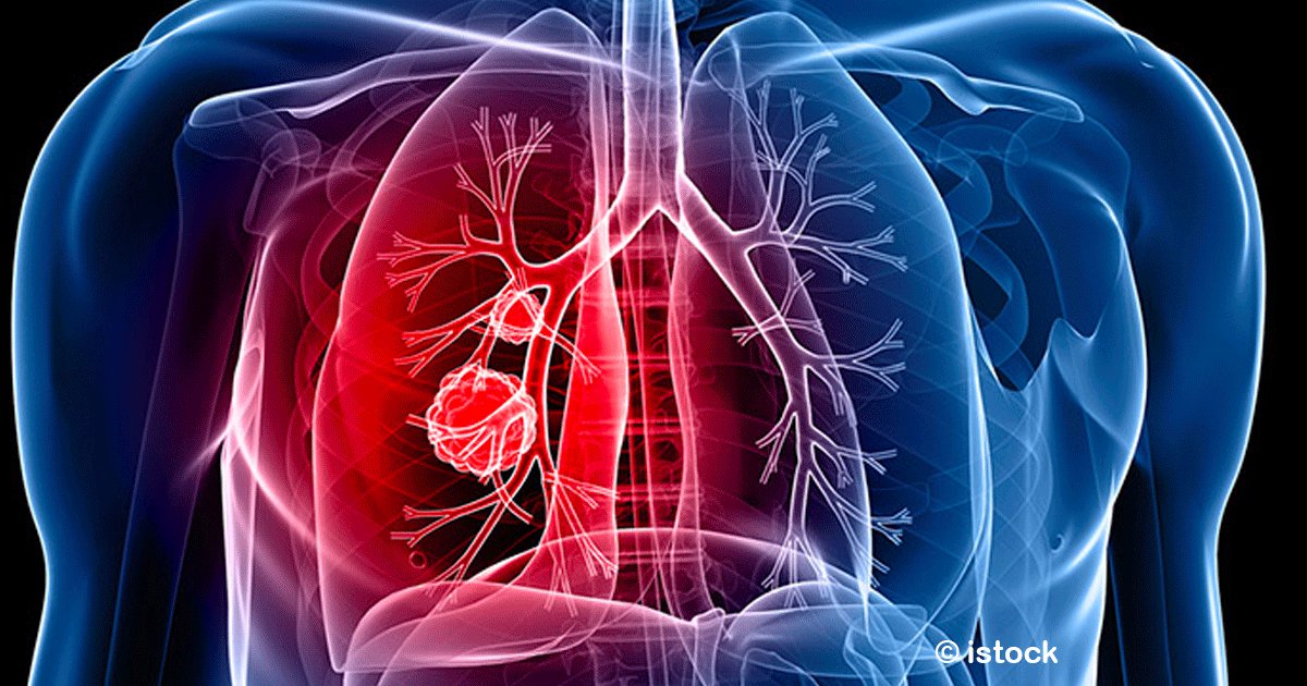 sin titulo 1 21.png?resize=1200,630 - Síntomas silenciosos del cáncer de pulmón, conocerlos podría salvar a muchas personas