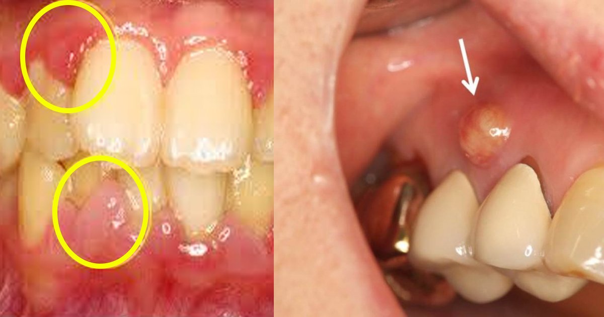 teeth 1.jpg?resize=1200,630 - 歯茎が腫れてしまった時の対処法は？たまに腫れることあるよね