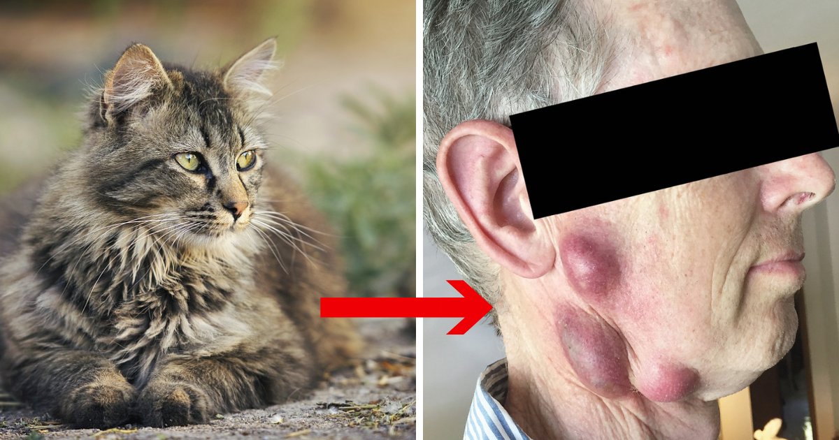 untitled design 11 2.png?resize=1200,630 - Homem pega doença rara de gato e adverte outros sobre os perigos