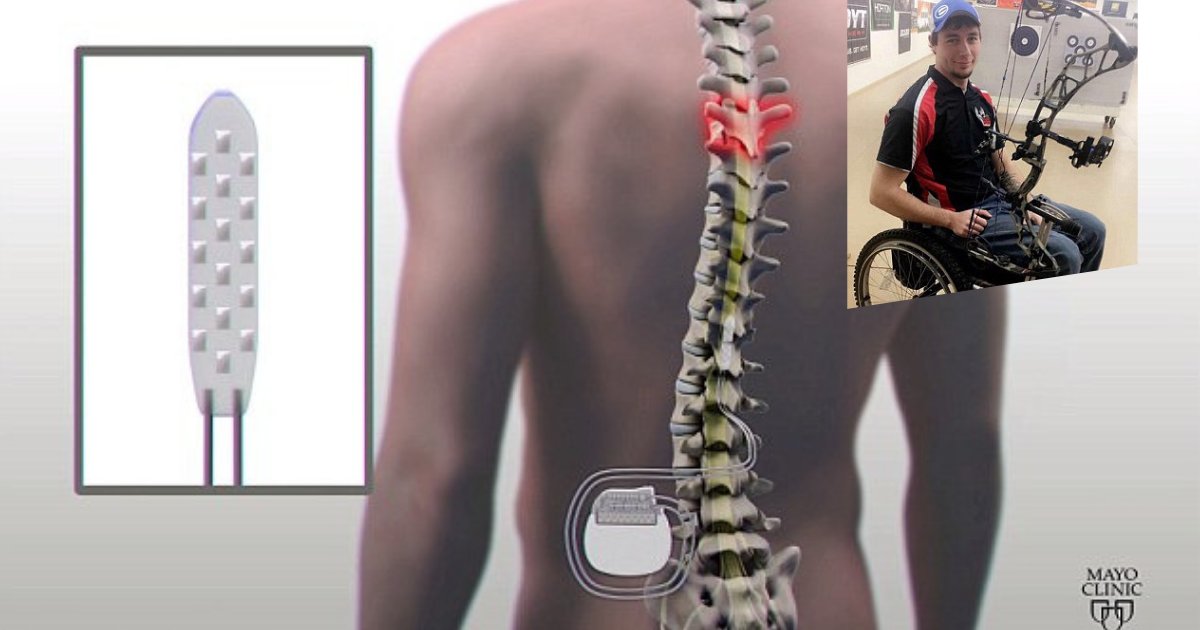 untitled design 59.png?resize=1200,630 - Un implant de la colonne vertébrale aide trois personnes paralysées à marcher à nouveau en répondant à leurs pensées!