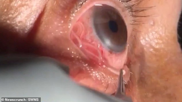 Des médecins surpris ont repéré le parasite, qui mesurait 15 cm, se tortillant dans l'un de ses globes oculaires et l'ont retiré (photo: le ver en train d'être enlevé)