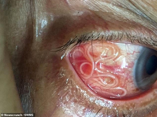 Le patient indien, originaire d'Inde, s'est plaint de douleurs et de démangeaisons aux yeux et a décidé de demander de l'aide médicale (photo: le ver dans l'homme