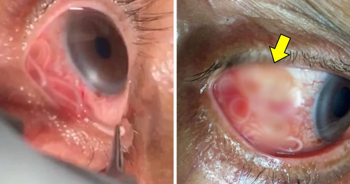 ads.jpg?resize=1200,630 - Moment extrêmement dégoûtant: un médecin enlève un ver parasite de 15 cm de longueur dans les yeux d'un homme