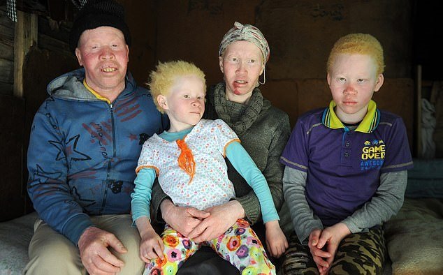 albinism-1