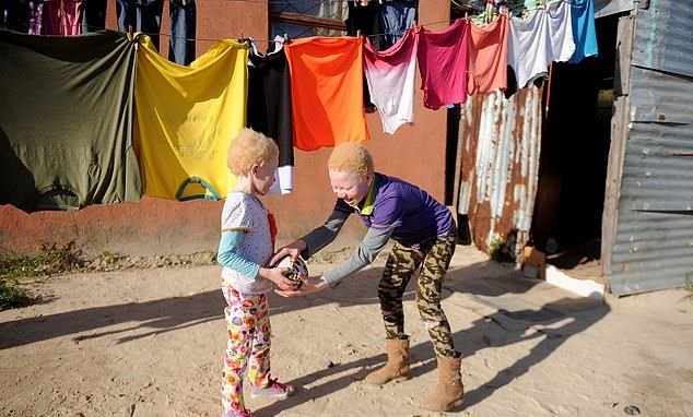 albinism-2