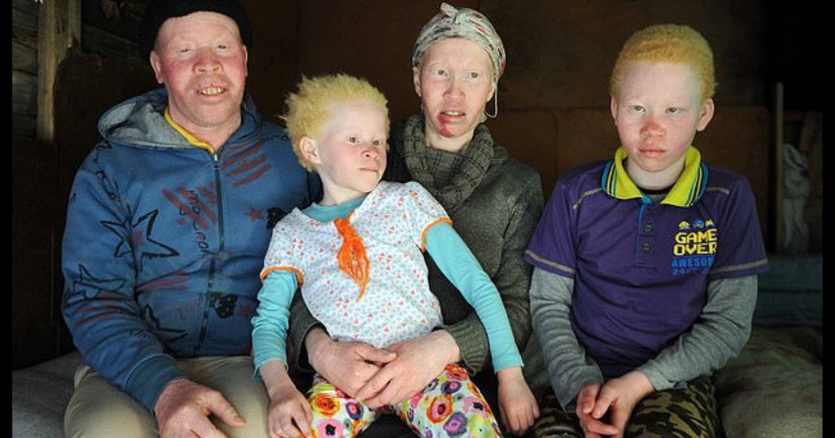 d5 1.png?resize=1200,630 - Une famille souffrant d'albinisme révèle à quel point il est difficile de vivre avec la maladie et la discrimination qui s'y opposent