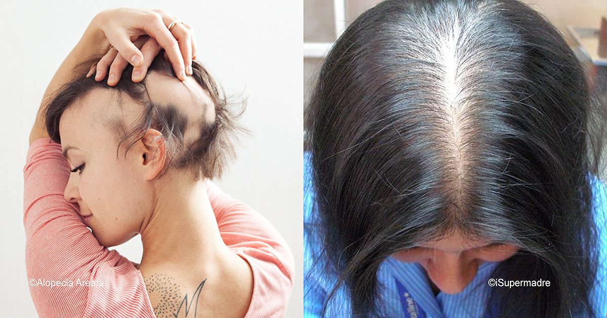 diff 3.jpg?resize=412,275 - Todo sobre la alopecia femenina y sus tratamientos