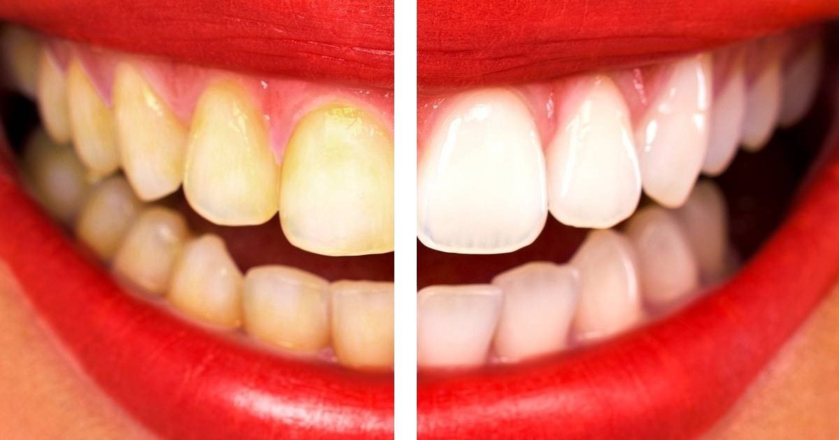 featured image 42.jpg?resize=1200,630 - 9 façons naturelles de blanchir vos dents