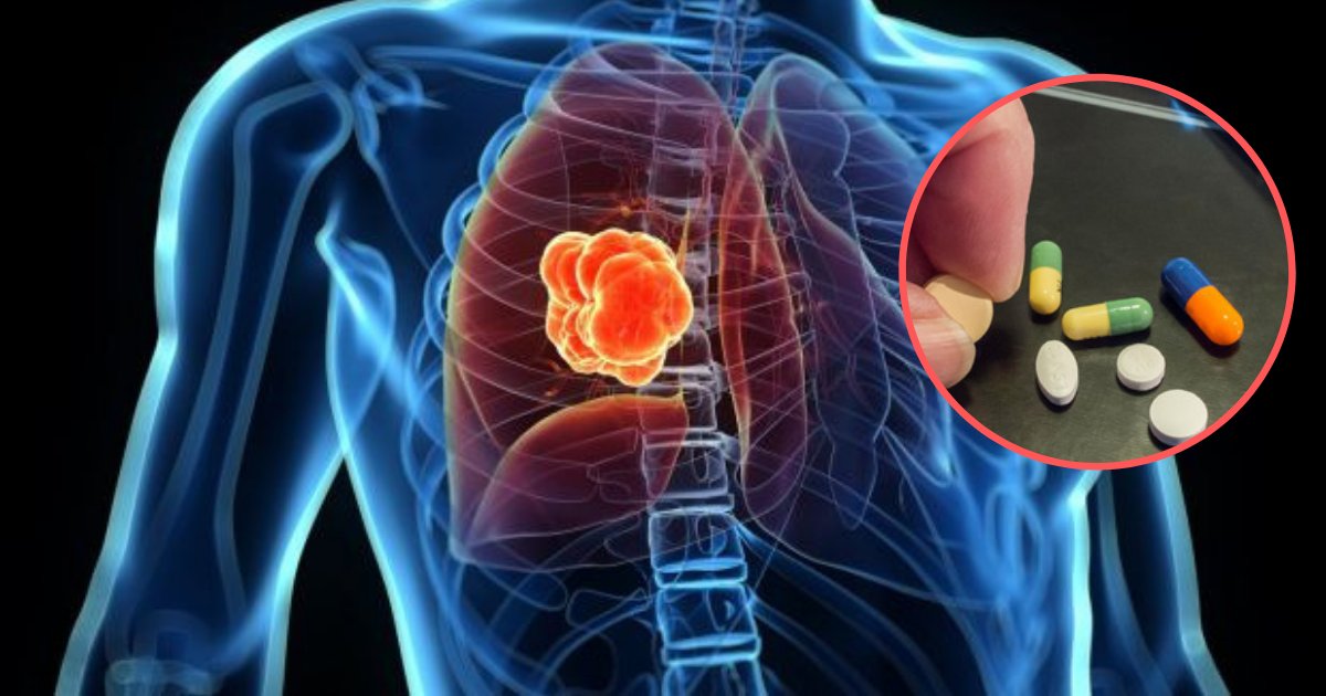 s1 3.png?resize=412,275 - Les scientifiques avertissent que des pilules pour la tension artérielle augmentent le risque de cancer du poumon