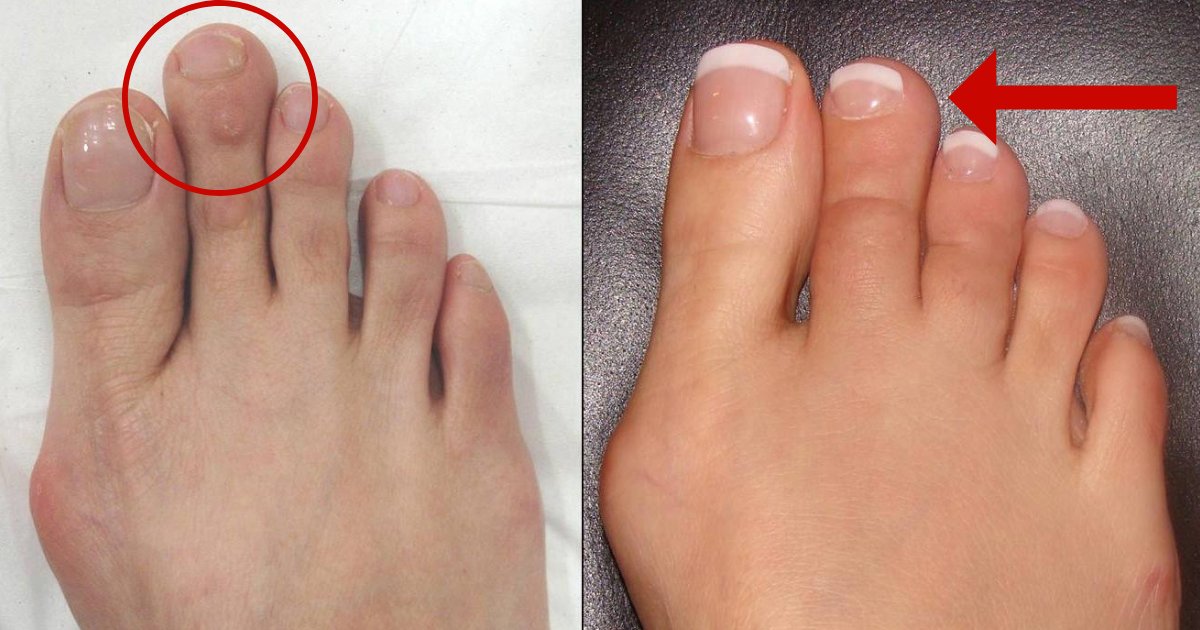toe5.png?resize=1200,630 - El acortamiento del dedo del pie es en realidad más común de lo que piensas