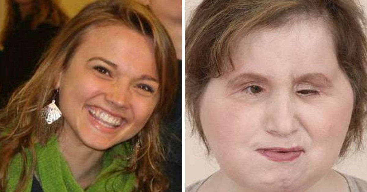untitled design 75.png?resize=412,275 - Menina de 22 anos passa por transplante de face após tentativa de suicídio falhar