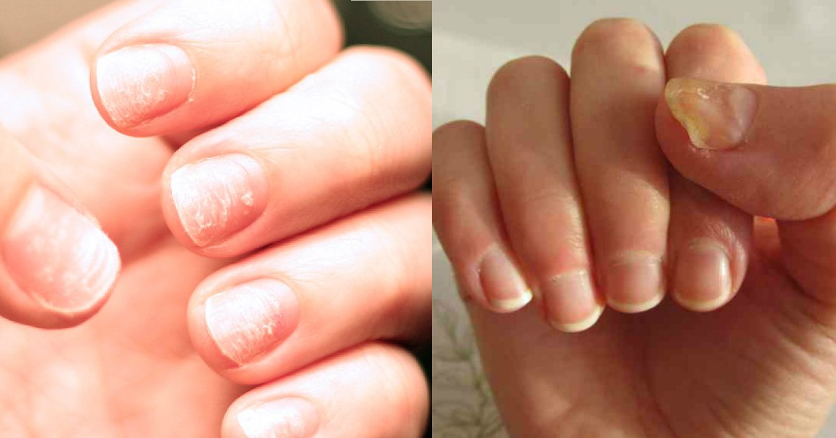1 72.jpg?resize=412,232 - How Your Fingernails Might Indicate Something Is Wrong With Your Health