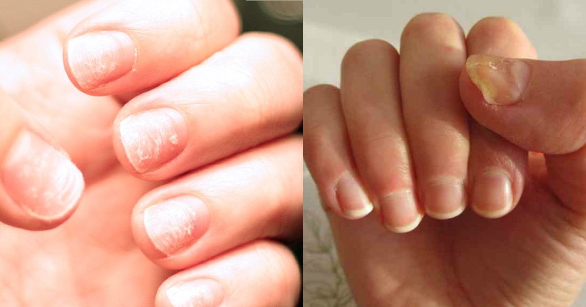 1 72.jpg?resize=412,275 - How Your Fingernails Might Indicate Something Is Wrong With Your Health