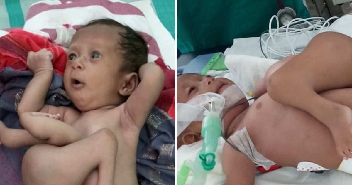 baby5.png?resize=1200,630 - Une petite fille née avec un jumeau parasite qui sortait de sa poitrine est sauvée par des chirurgiens