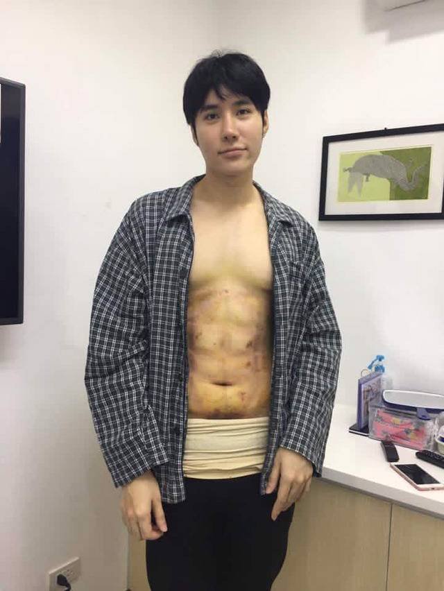 태국 남자 전신 근육 성형.jpg | 인스티즈