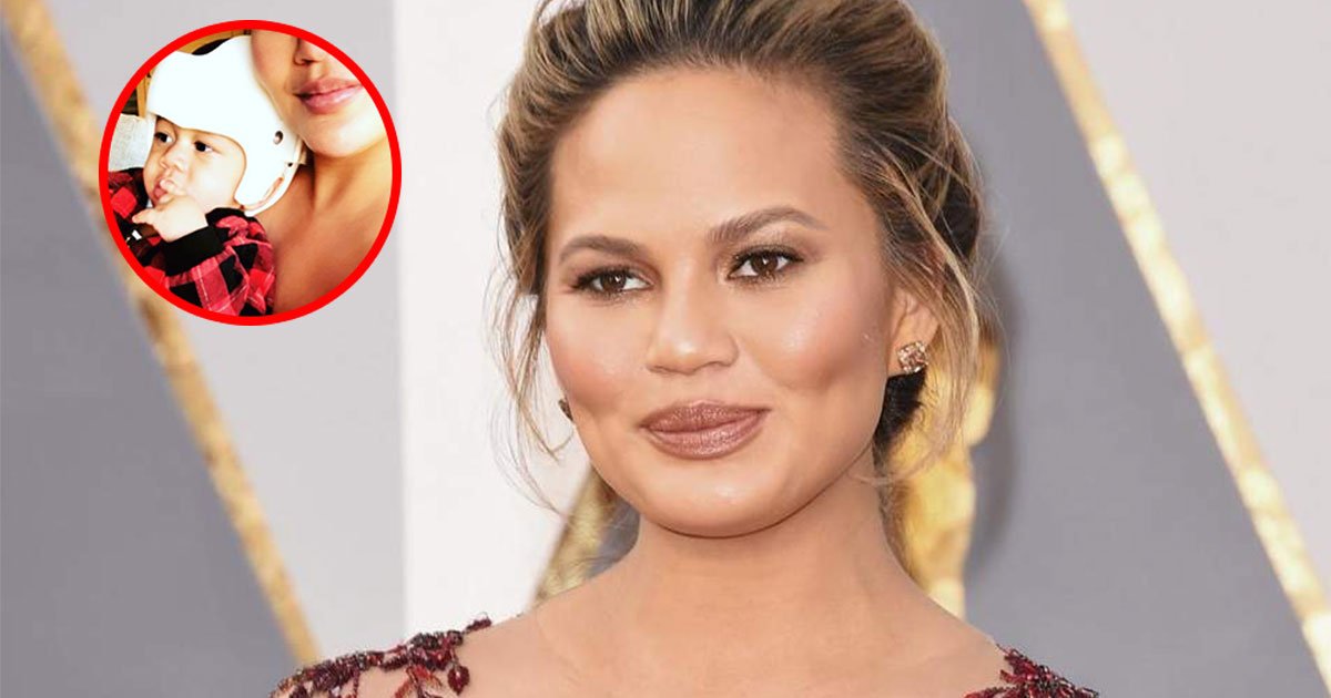 Chrissy Teigen A Publie Une Photo De Son Fils Qui A La Tete Plate Et Portant Un Casque De Correction Vonjour