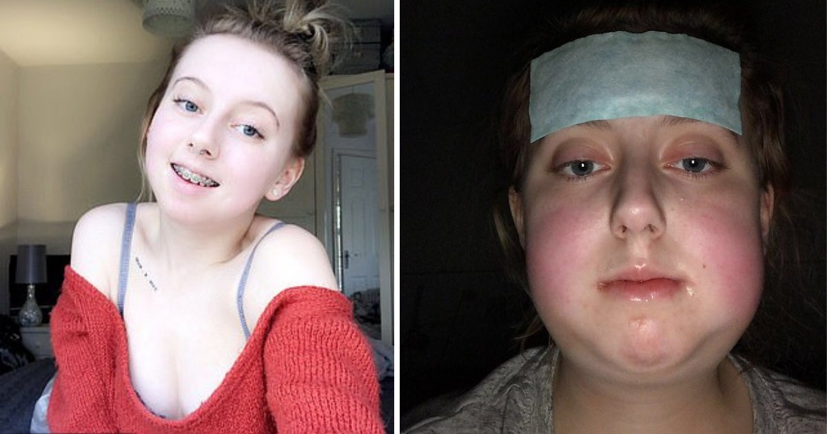 d1 11.png?resize=412,232 - Teenager Underwent Corrective Surgery After Being Bullied For Years