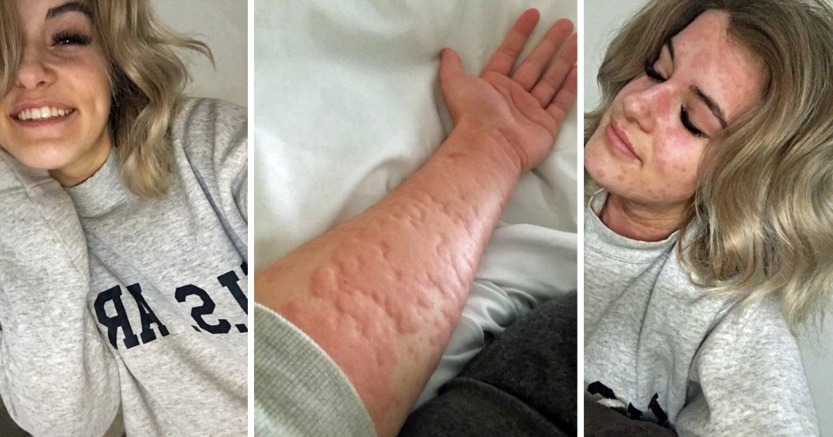 21 Year Old Woman Is Allergic To Winter And Cold Weather Can Leave Her   D3 