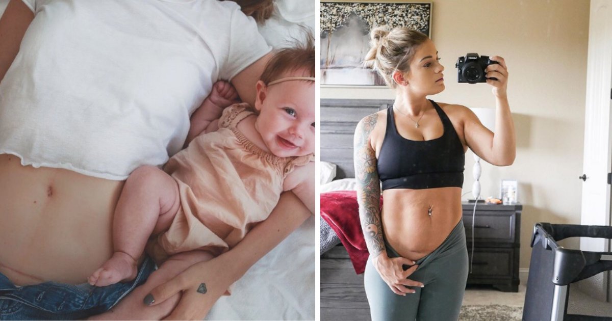 Moms Go Bold and Share Photos of Their C-sections