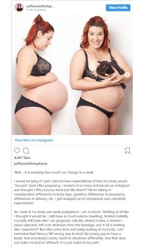 Les mamans vont en gras et partagent des photos de leurs césariennes