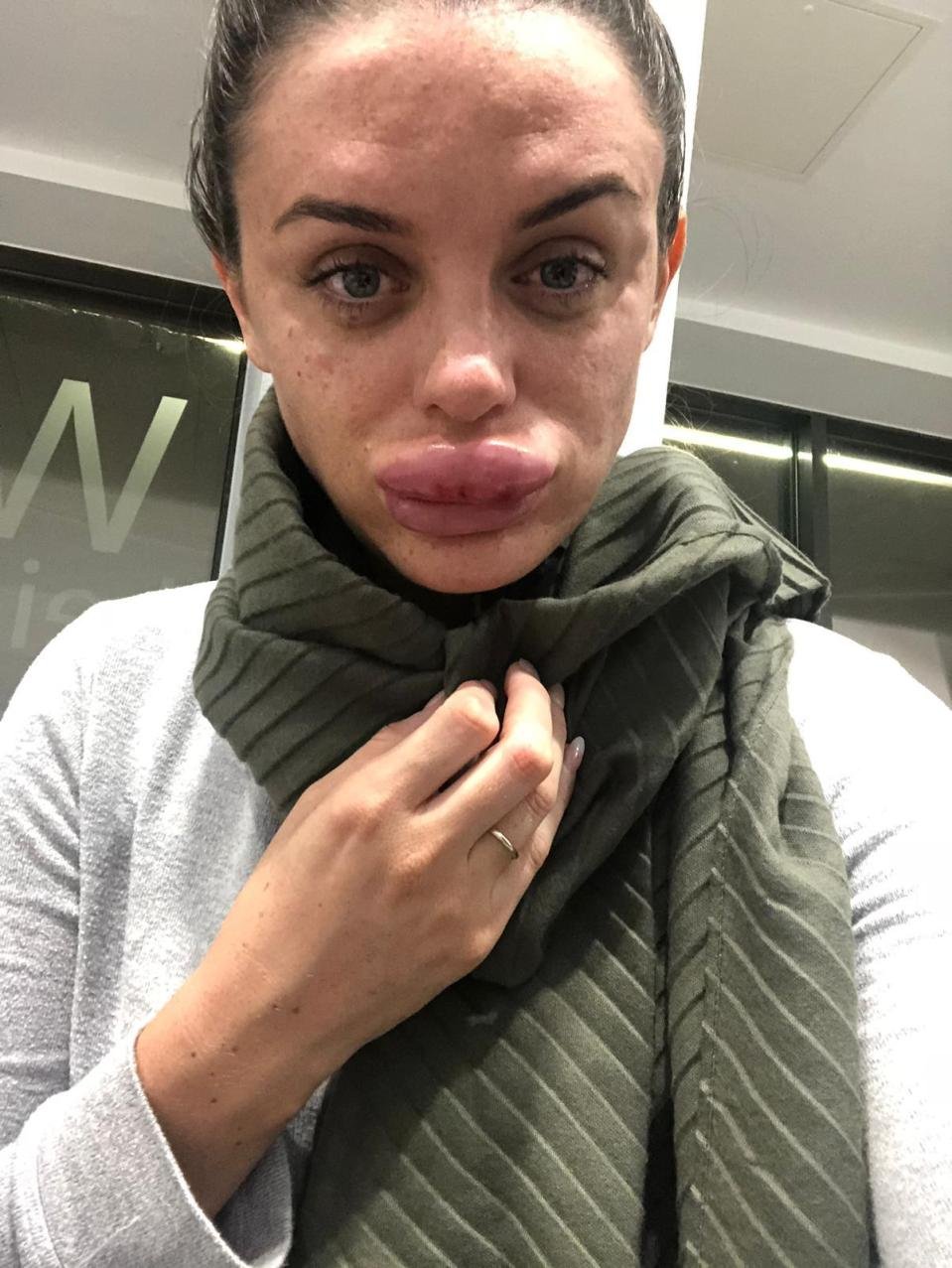 Botox Gone Wrong Woman S Lips Left Swollen After Getting Fillers From   Rachael Knappier 3 