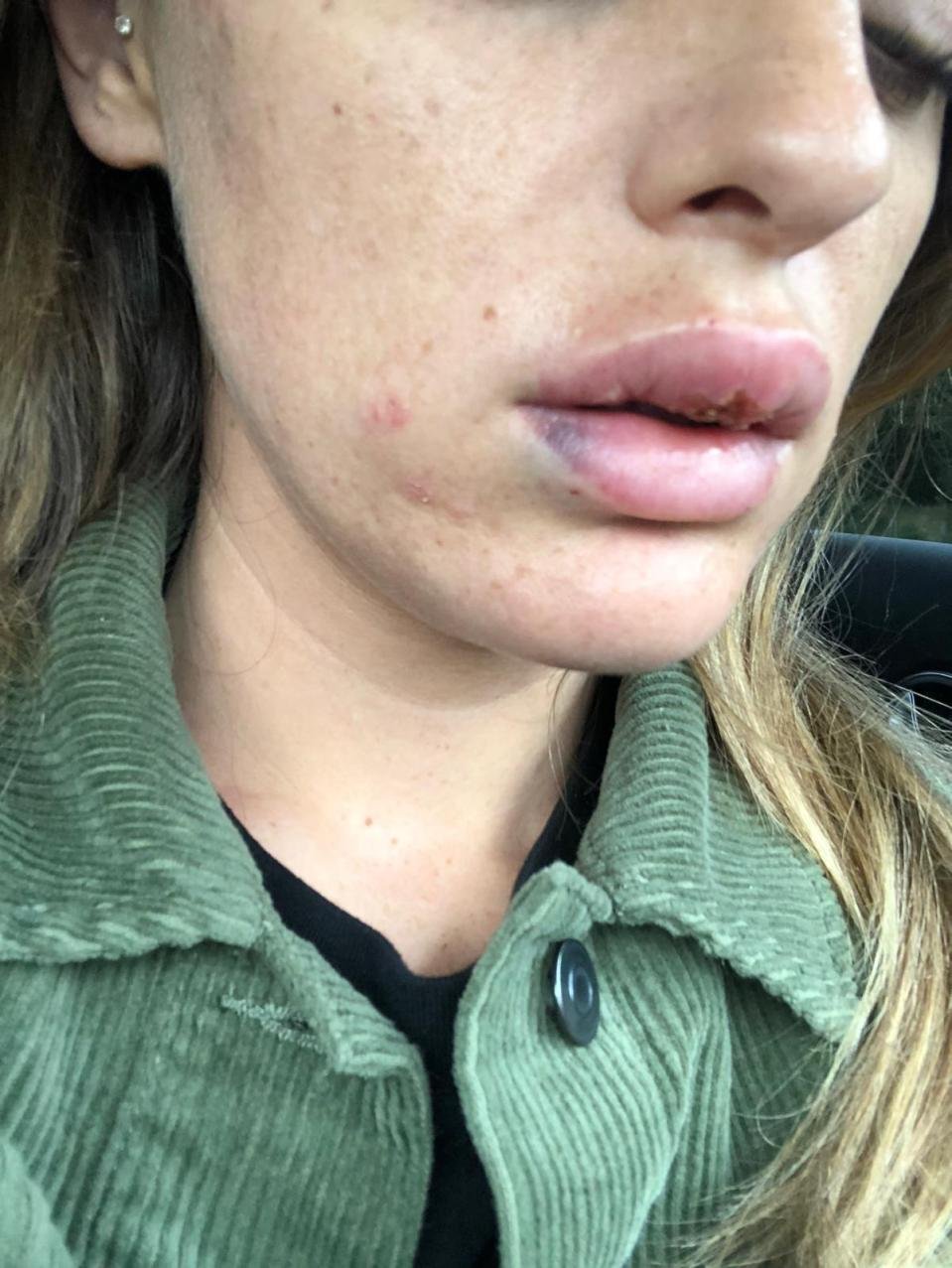 Botox Gone Wrong Womans Lips Left Swollen After Getting Fillers From 1095