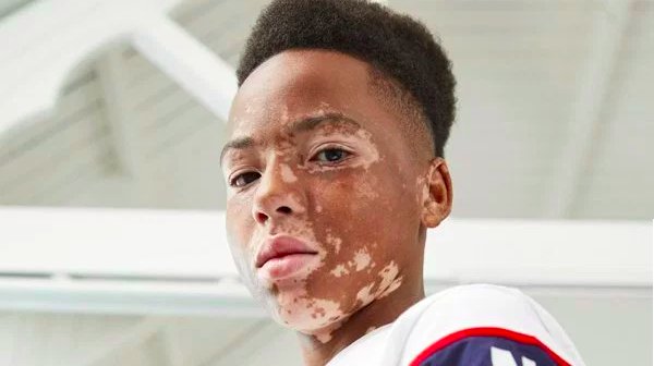 img 5c3d10e9336bd.png?resize=1200,630 - La dernière campagne de Primark met en vedette un adolescent atteint de vitiligo
