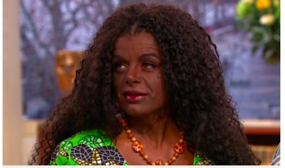 Cette Femme A Change Sa Couleur De Peau En Utilisant Des Injections De Melanine Vonjour