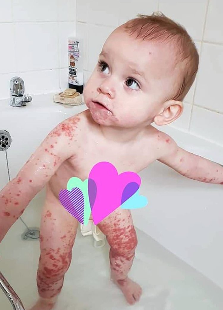 Un Bebe Passe 4 Jours A Se Battre Pour La Vie Apres Avoir Ete Embrasse Par Un Membre De Sa Famille Avec Un Bouton De Fievre Vonjour Un Bebe Passe 4 Jours A Se Battre Pour La Vie Apres Avoir Ete Embrasse Par Un Membre De Sa Famille Avec Un Bouton De Fievre Vonjour