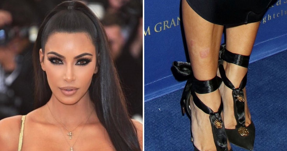 kimkardashian.png?resize=412,232 - Kim Kardashian demande de l'aide à ses fans, alors que ses plaques de psoriasis ont déjà envahi son corps