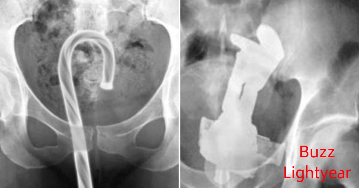 object11.png?fit=1024%2C538&ssl=1&strip=all - Very Unusual Objects Stuck Inside People’s Orifices That Required ER Visits Have Been Revealed