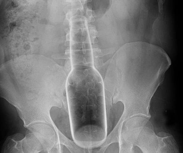 Very Unusual Objects Stuck Inside Peoples Orifices That Required Er 