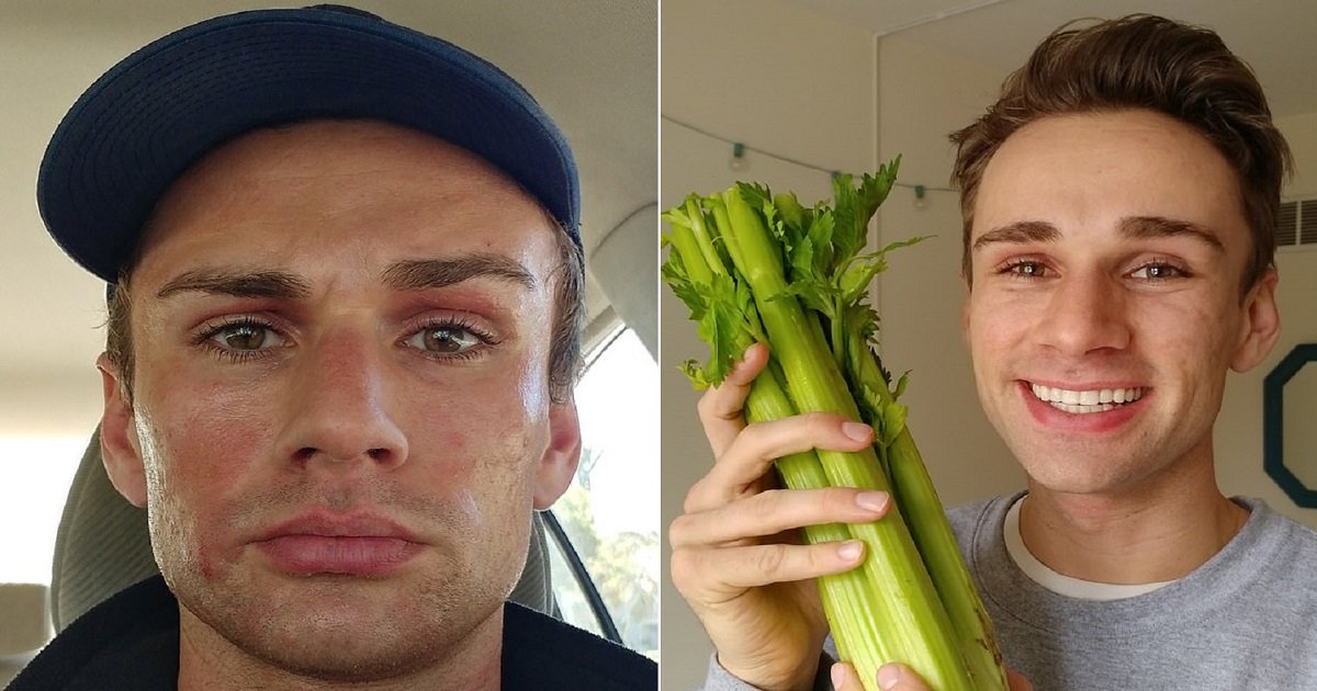a3 3.jpg?resize=1200,630 - Young Actor Reveals How Raw Vegan Diet And Daily Celery Juice Cured His Painful And Long-Running Eczema