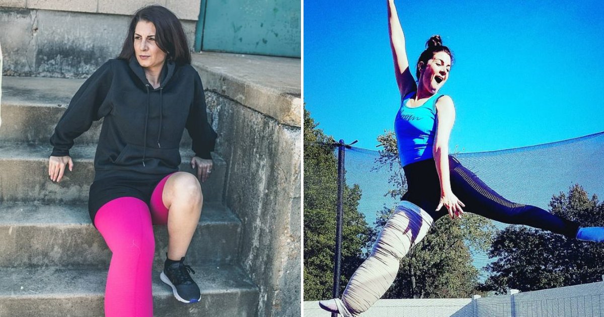 amy7.png?resize=412,275 - Woman With Rare Condition Has Right Side Of Her Body Bigger Than The Left