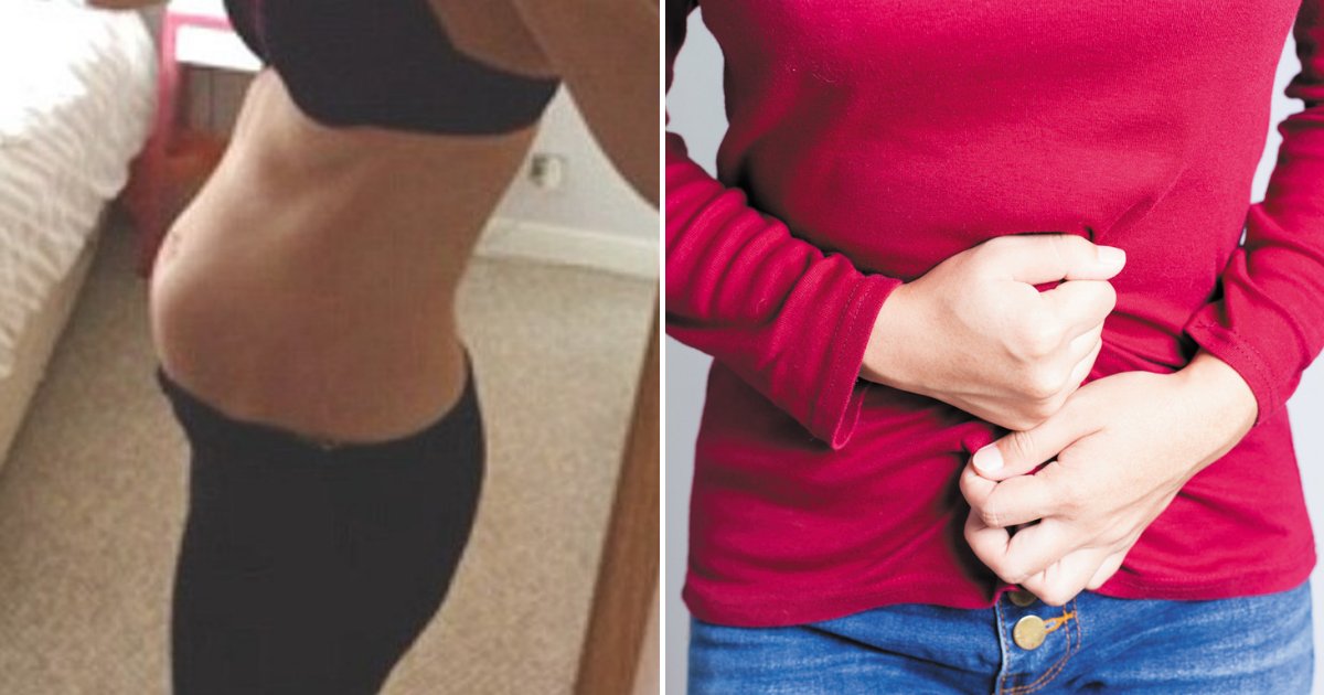 bloated1.png?resize=412,275 - 21-Year-Old Woman Whose Stomach Was Bloated For Months Discovered What Took Up Most Of Her Abdomen