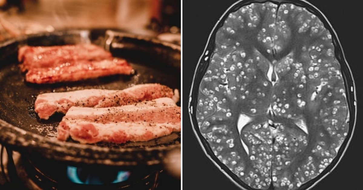 brain 1.png?resize=412,275 - Teen Passed Away After Eating Under-Cooked Pork That Caused Parasitic Larvae To Invade His Brain