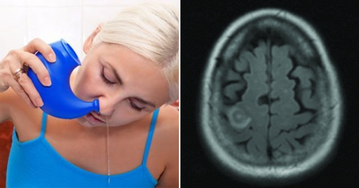brain3.png?resize=1200,630 - Doctors Issue Warning After Woman Dies From Using Tap Water To Clear Sinuses