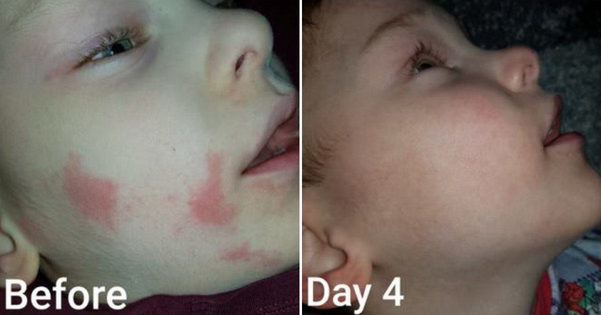 eczema.png?resize=412,275 - $6 Miracle Cream Cured Boy's Severe Eczema In Only Four Days