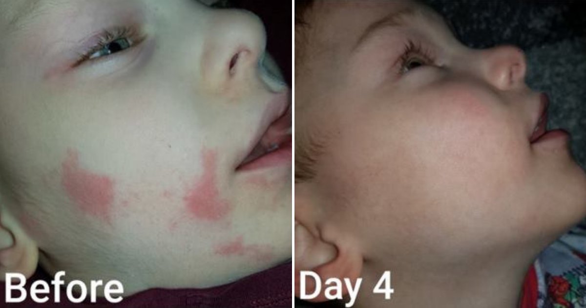 eczema.png?resize=412,232 - $6 Miracle Cream Cured Boy's Severe Eczema In Only Four Days