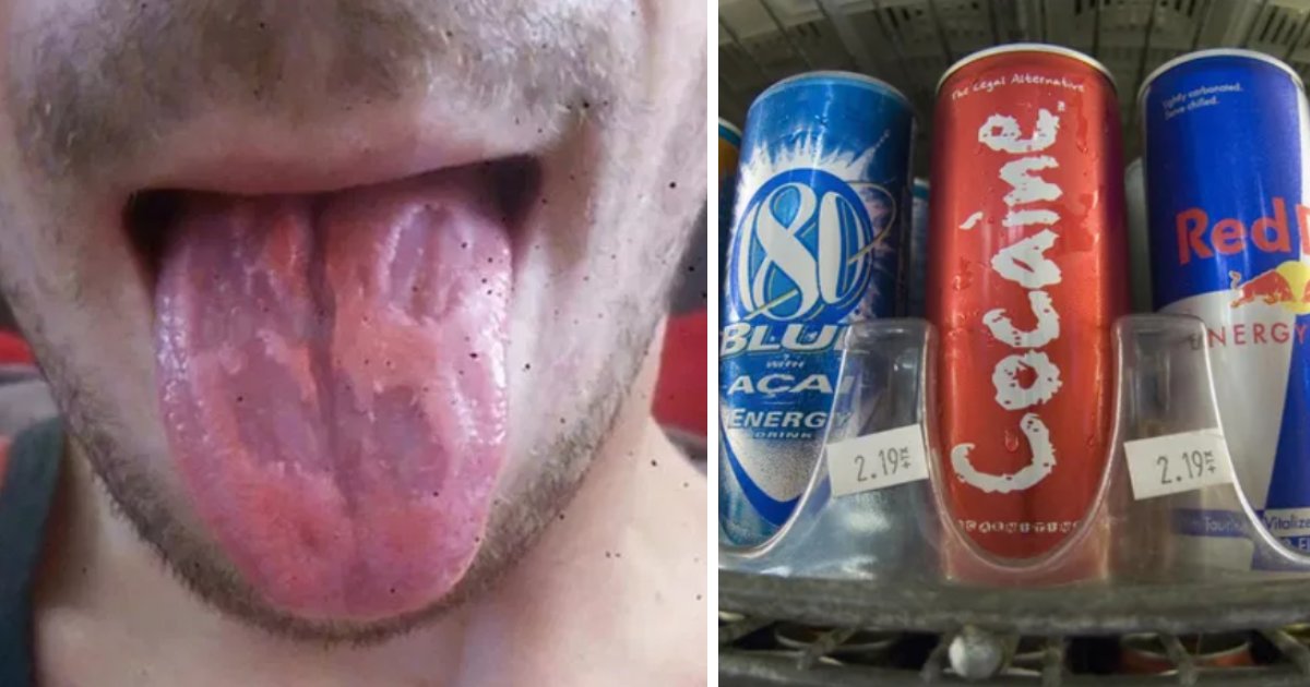 Man S Tongue Eaten Away After He Became Addicted To Energy Drinks Small Joys