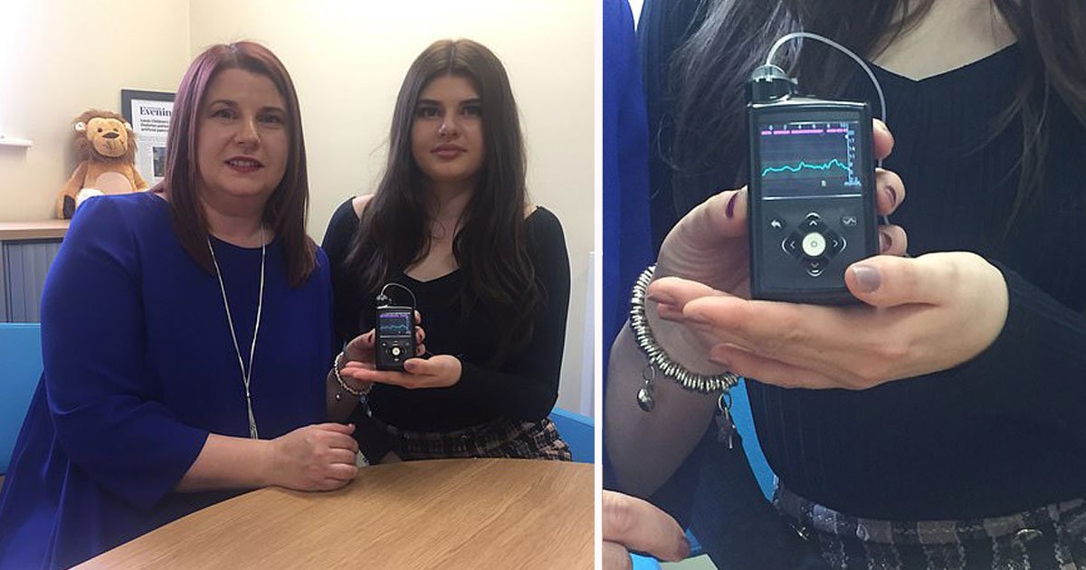 girl with diabetes.jpg?resize=412,232 - 17-Year-Old With Type 1 Diabetes Has An Electronic Insulin Pump Installed Which Automatically Injects Insulin