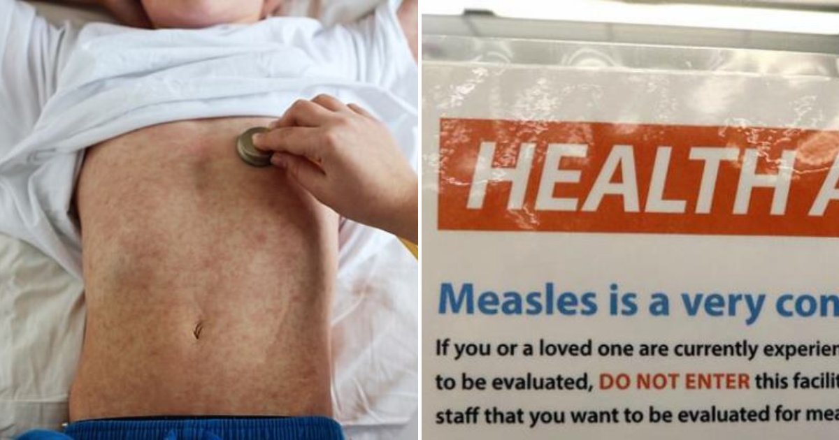 measles3.png?resize=1200,630 - Unvaccinated Boy, 5, Reintroduces Measles Five Years After The Country Eradicated The Disease